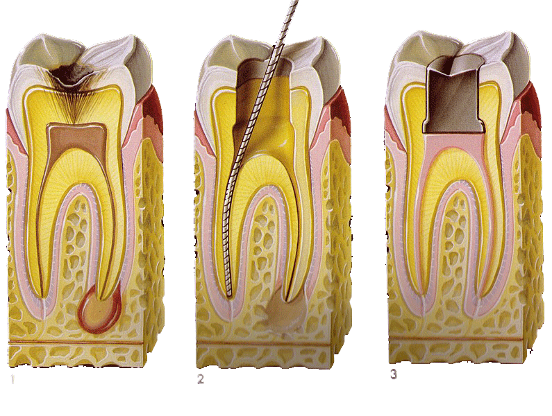 3 канала в зубе